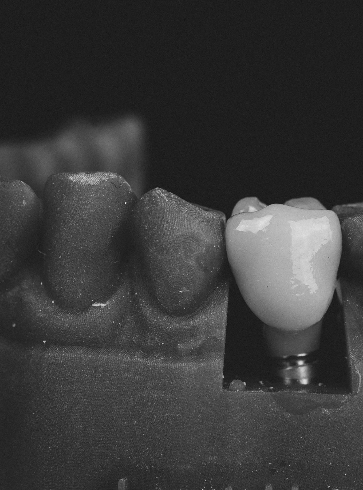 Dental Implants